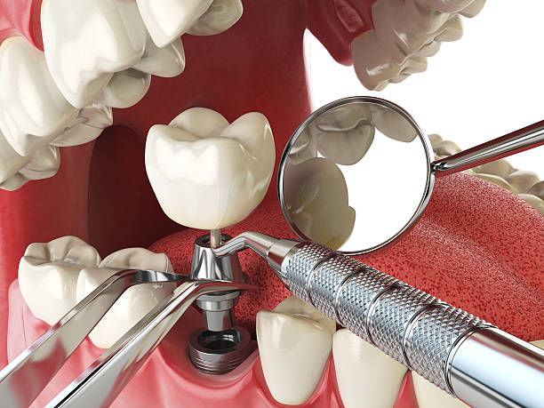 Best Emergency Root Canal Therapy in Laurens, SC